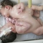 RSU Soetomo Rawat Bayi Kembar Siam Dempet Perut
